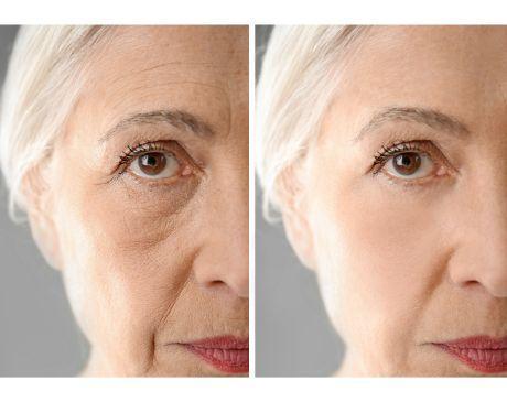 بوتاکس در چه سنی