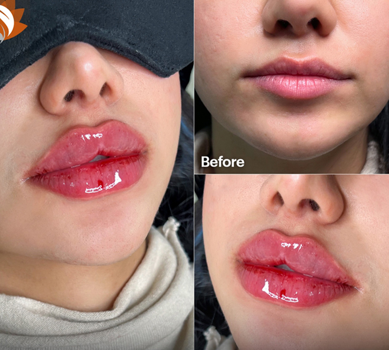 تزریق ژل لب روسی دکتر نیلوفر ترکاشوند (1)