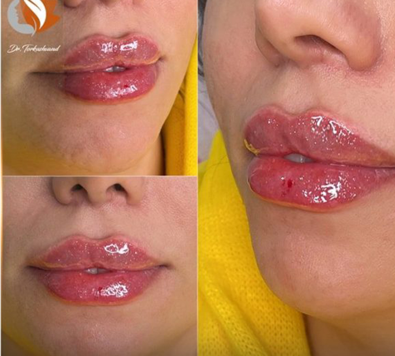 تزریق ژل لب روسی دکتر نیلوفر ترکاشوند (8)