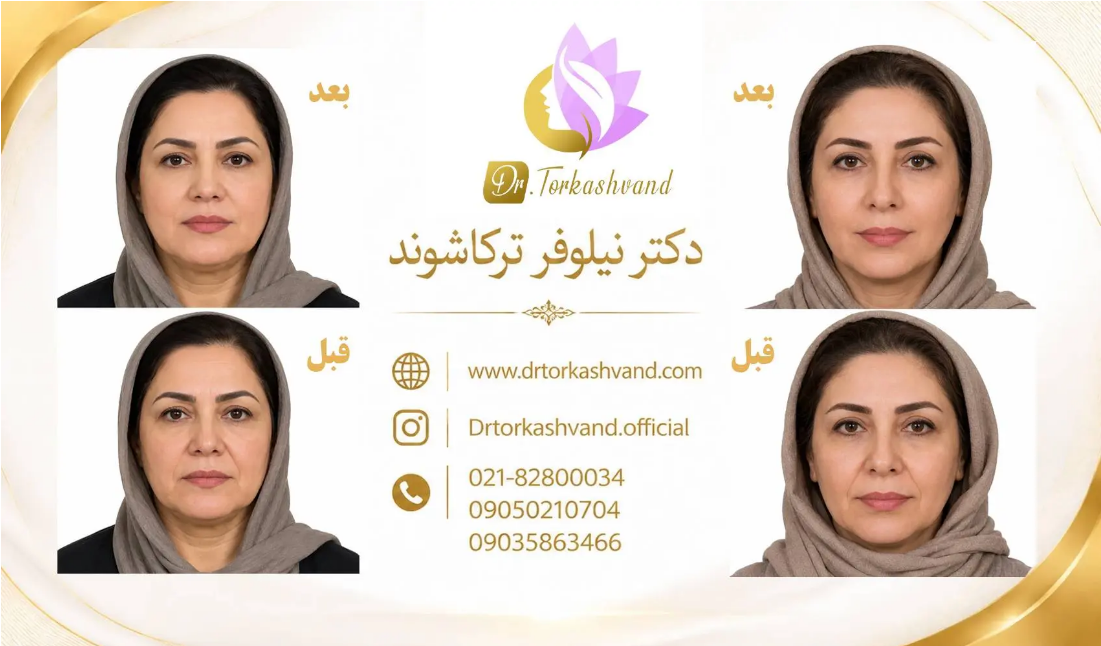 تزریق فیلر خط خنده