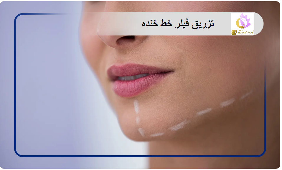 تزریق فیلر خنده