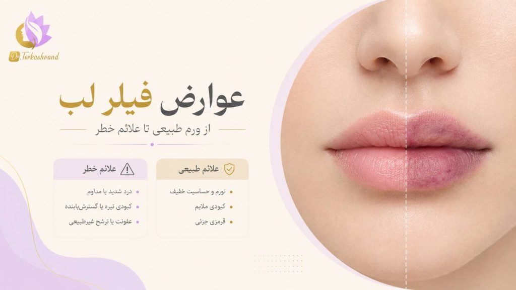عوارض فیلر لب چیست؟ ورم طبیعی تا علائم خطر