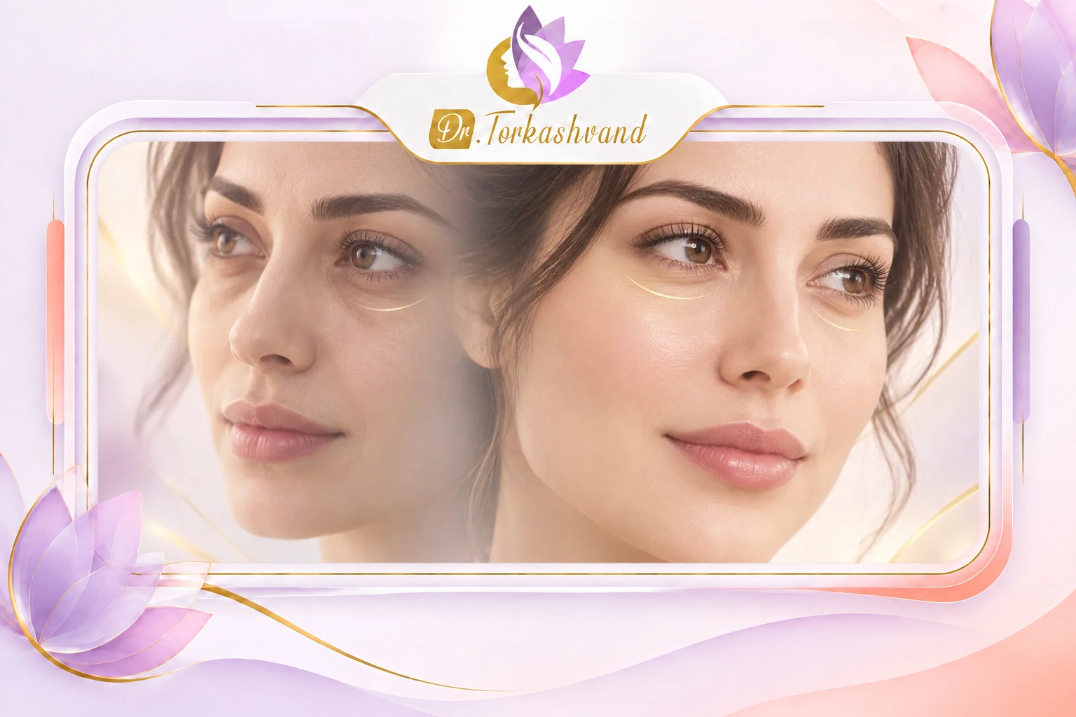 فیلر زیر چشم؛ رفع گودی و کاهش تیرگی دور چشم بدون جراحی 6